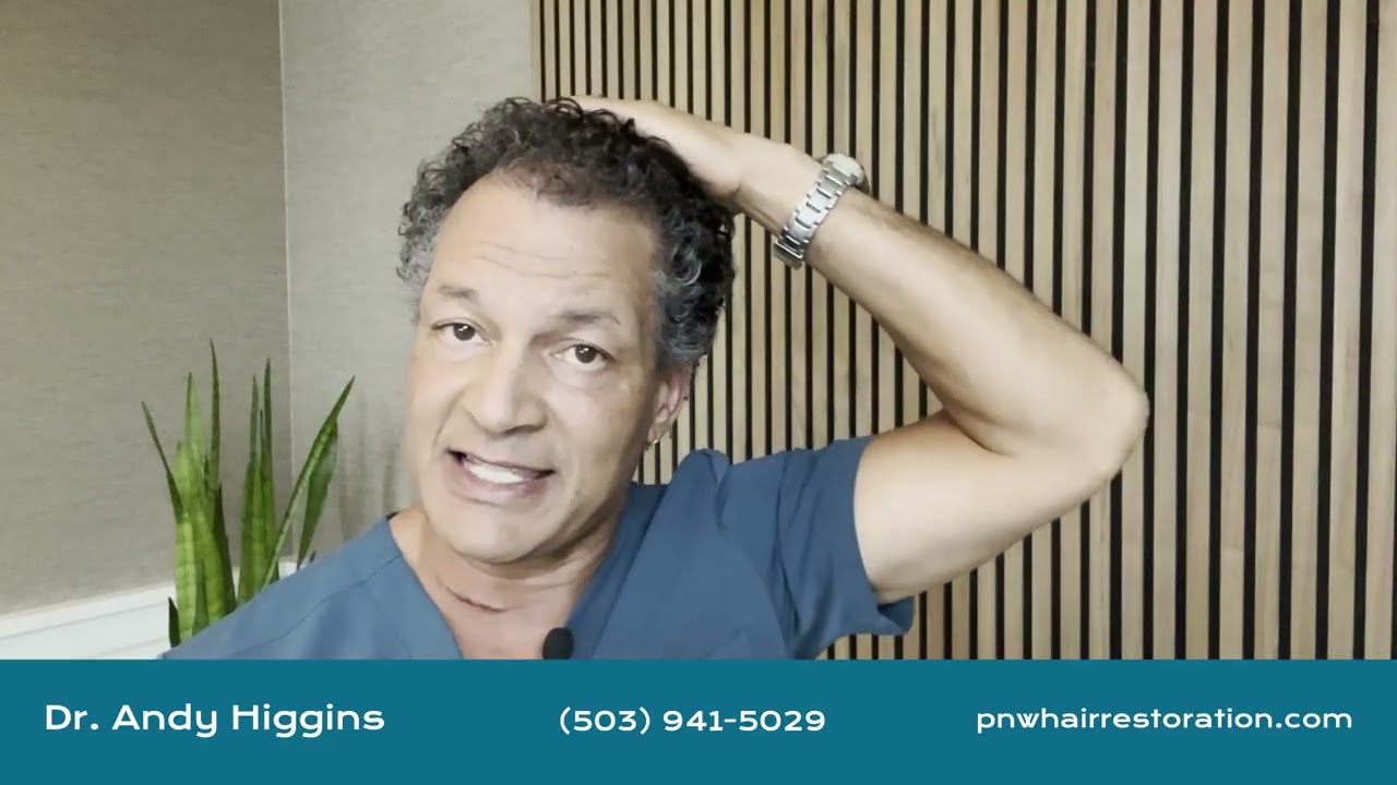 Are hair transplantation results permanent?