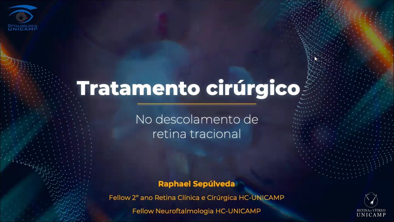 Retina e Vítreo (21/11/2024) - Tratamento Cirúrgico no Descolamento de Retina Tracional