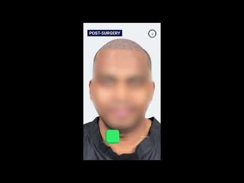 Amazing Hair Transplant Surgery in India | Using The Latest Technology & Techniques