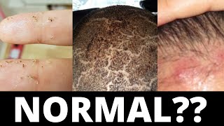 These 3 Things Are Normal After A Hair Transplant