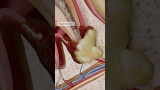 How does a Chronic Apical Abscess develop A 3D visualization with VOKA