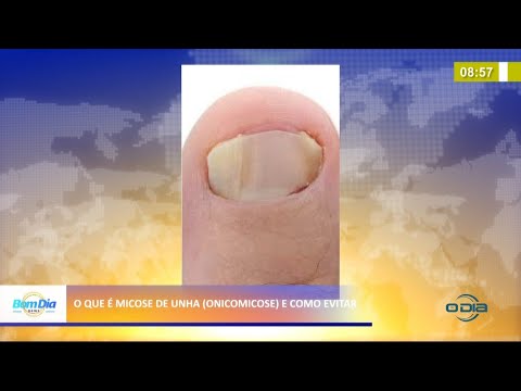 O que é micose de unha (Onicomicose) e como evitar 18 03 2021