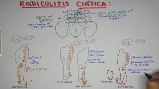 Radiculitis Ciática L4 L5 S1 - Hernia de disco lumbar