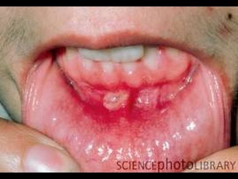 a száj körül vörös foltok hámoznak mit kell tenni hogyan lehet gyorsan eltávolítani a vörös foltokat a tisztítás után