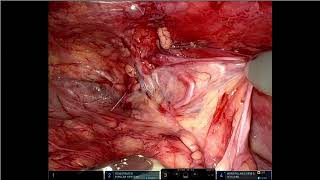 V10-01: Robotic-Assisted Transabdominal Preperitoneal Hernia Repair