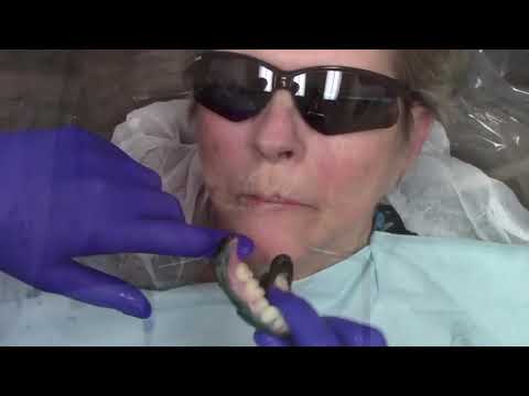 LOCATOR R-Tx — Uncovery, Abutment Placement & Impressions