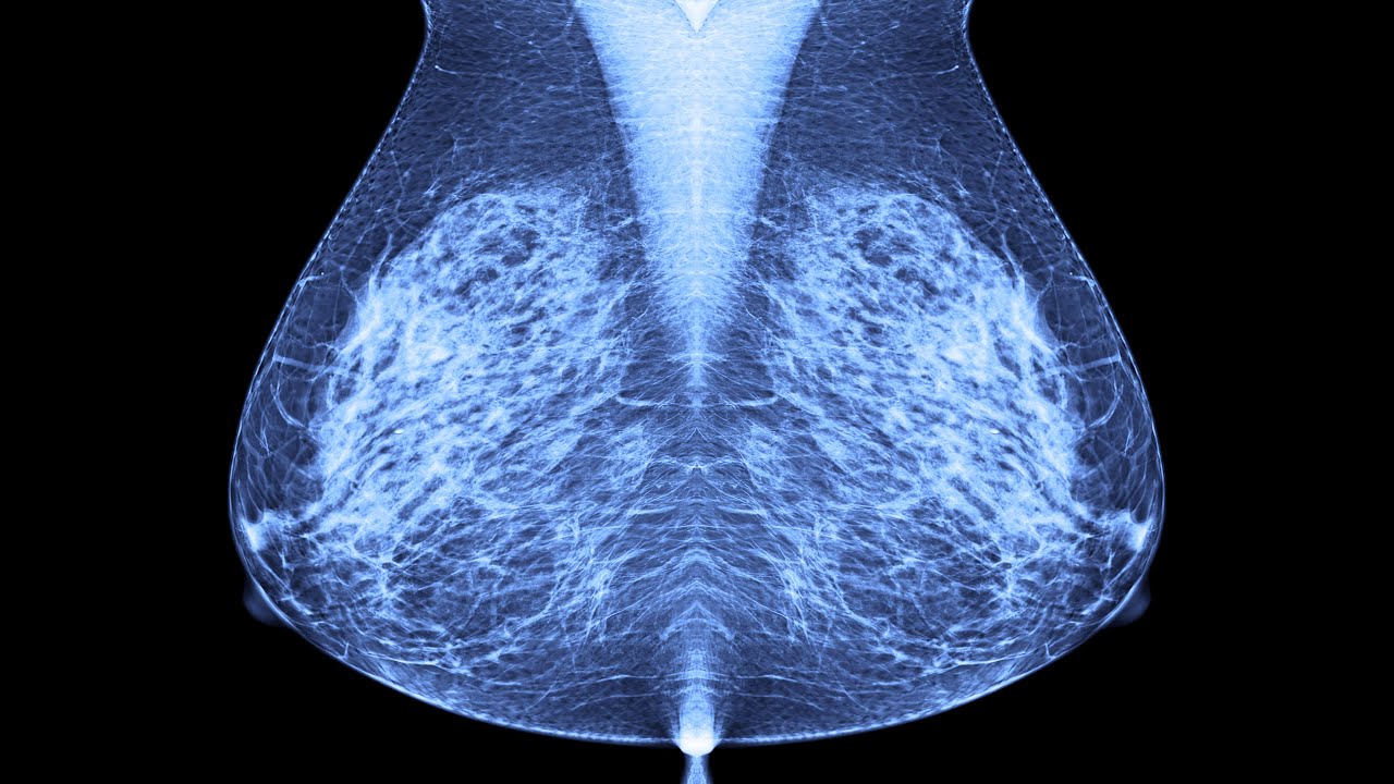 A Discussion On Breast Malignancy And Military Burn Pit Exposure