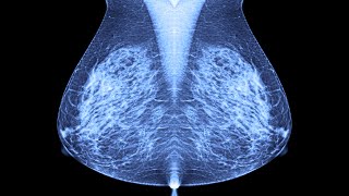 A Discussion On Breast Malignancy And Military Burn Pit Exposure