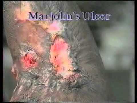 Examination of an ulcer