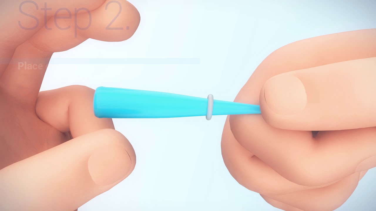 TagBand Skin Tag Removal Kit