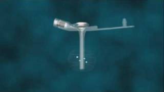 Product video: 14 Fr AMT Mini ONE Balloon Button Low Profile G-Tube