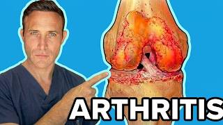 Treating Arthritis Without Surgery