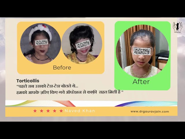 Torticollis Treatment