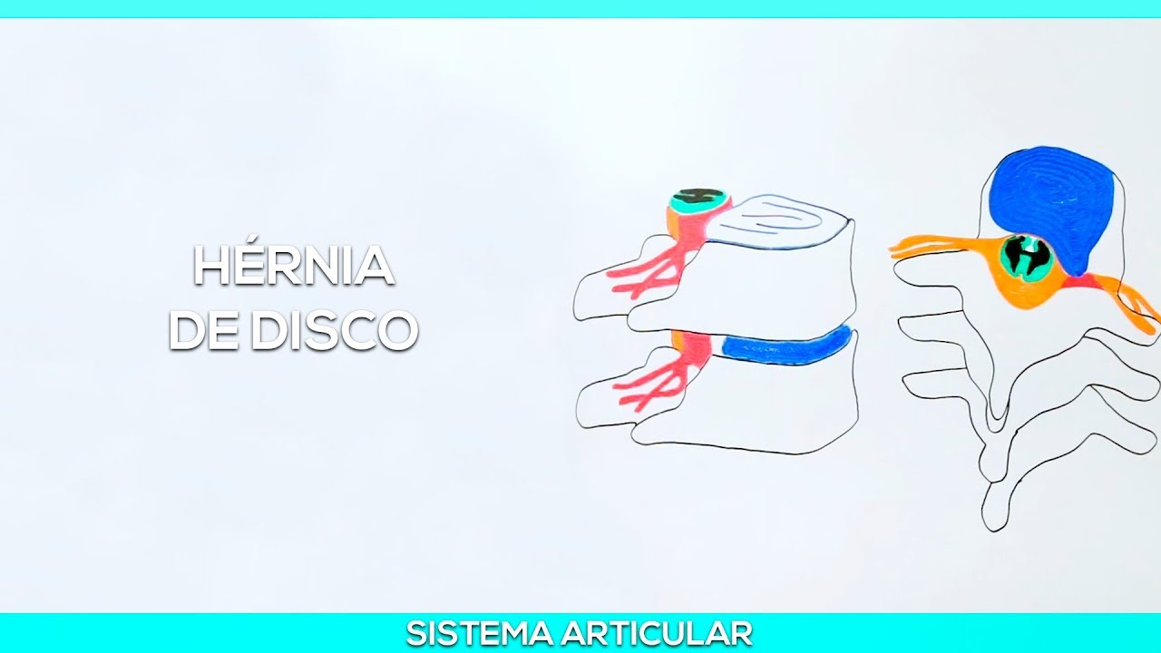 Hérnia de disco