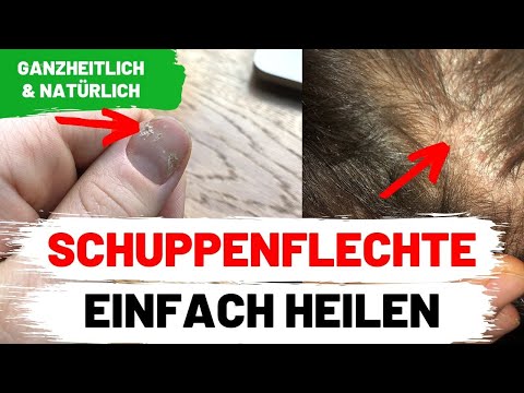 Schuppenflechte heilen - So habe ich es geschafft // Psoriasis Vulgaris, Nägel, Arthritis