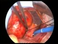Heart Surgery Minimally Invasive Aortic Valve Replacement