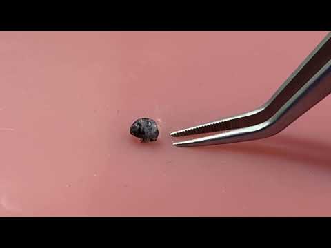 Zecke entfernen beim Kind - Zecken bei Kindern