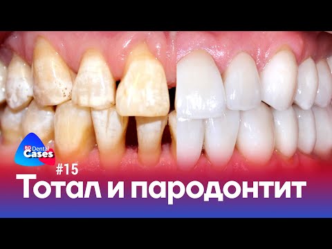 Тотальная реабилитация и пародонтит | Дентал кейсы от BG #15