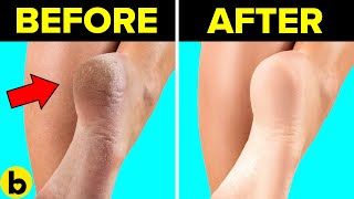 13 Easy Remedies You Can Use To Remove Calluses