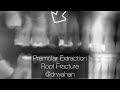 Premolar Extraction with Fractured Root - Dr Wahan Premolar Extraction with Fractured Root