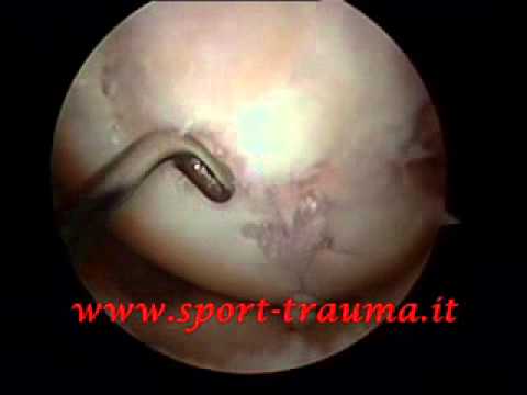 Trattamento di emergenza di malattia degenerativa del disco cervicale Come fai a sapere osteocondrosi della colonna cervicale