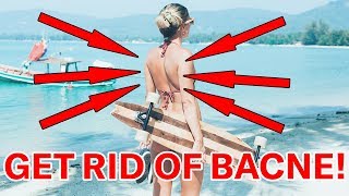 How To Get Rid Of Back Acne | Paula