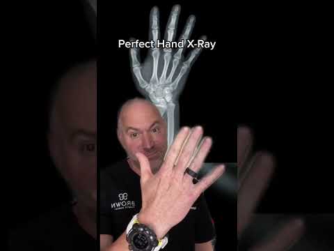 Worst Fireworks Injury Ever?! 😱 #shorts