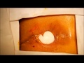 Lateral Internal Sphincterotomy For Chronic Anal Fissure Under Perianal Anaesthetic Infiltration