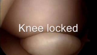 Knee Injury, The Locking Knee
