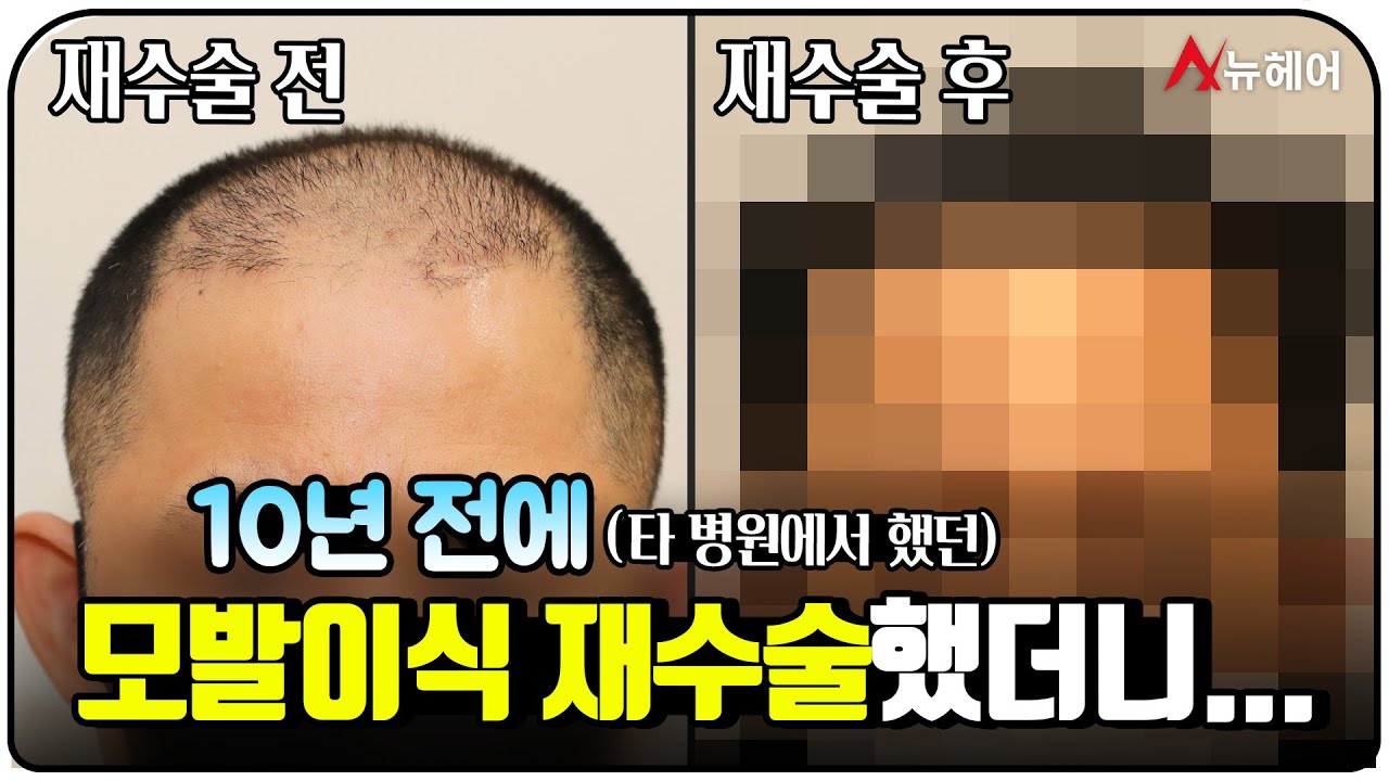 做了毛发移植再手术。 点击查看结果 ㅣ New Hair