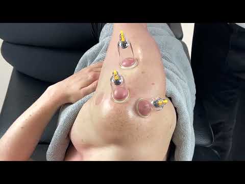 Cupping Placement Chart