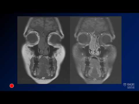 Neuroradiology board review lecture 1 case 14