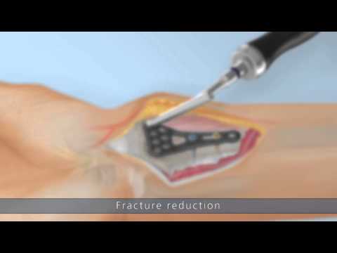 Ixos® Radius plate system P4 – Surgical technique