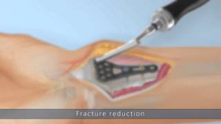 IXOS® | Radius plate system P4 | surgical technique