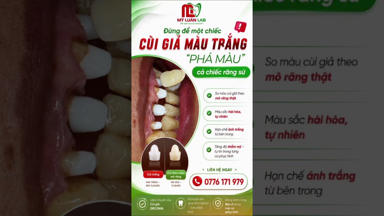 Đừng để một chiếc cùi giả màu trắng "PHÁ MÀU" cả chiếc răng sứ.