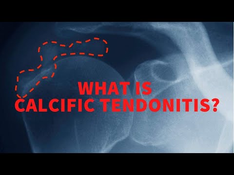 What is calcific tendonitis?