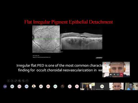 Pachychoroid CNV, CSC,PDT