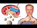 Clean Out Your Kidneys Of Oxalates And Stones Dr Berg