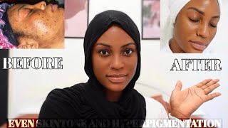 THE BEST PRODUCTS FOR EVEN SKINTONE ||BRIGHTENING, LIGHTENING HYPERPIGMENTATION AND PREVENTING ACNE