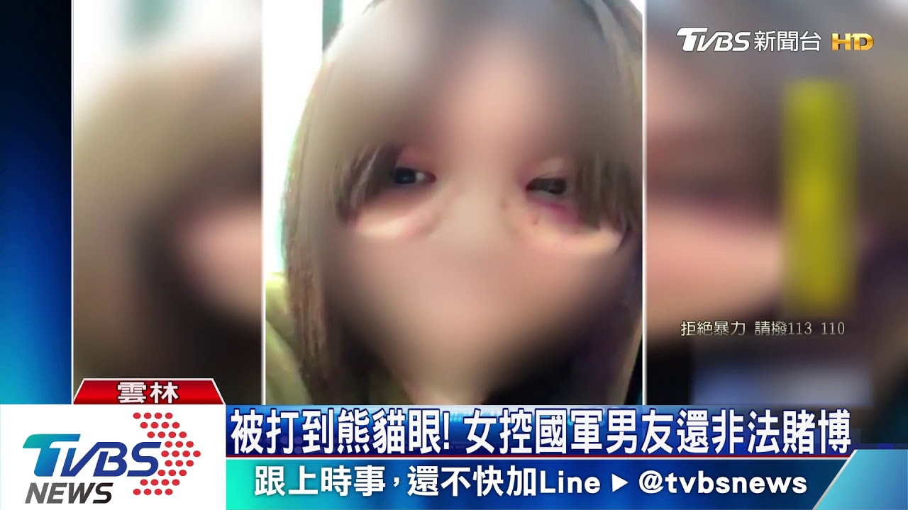 去年就有傷!女童眼眶瘀青 醫師:外力造成