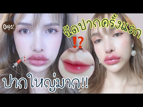 ฉีด ฟิลเลอร์ ปาก