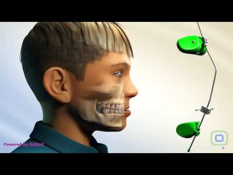 Orthodontic Appliance