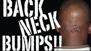 HOW to STOP BACK NECK BUMPS and KELOIDS: the Cause & the CURE / Part 1