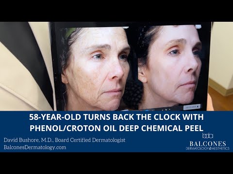58-Year-Old Turns Back the Clock with Phenol/Croton Oil Deep Chemical Peel | Dr. David Bushore