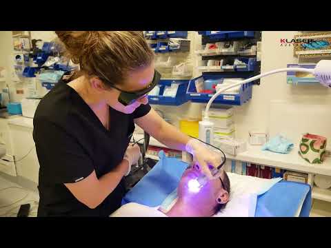 K-Laser Blue Derma - Carly Whytcross - Acne Scars with Fractional Laser