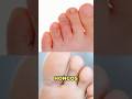 Así trata los hongos en los pies #drwilsondelgado #hongos #pies #tratamiento #tipsmedicos