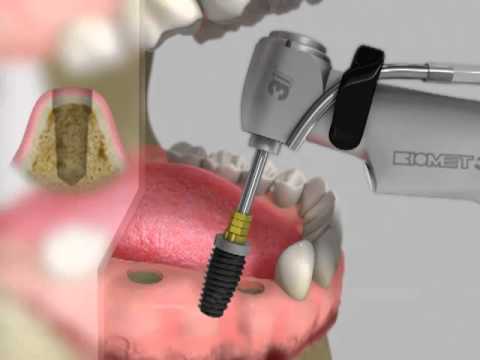Praxis Dr.Erhard - Einzelzahn Brückenbehandlung