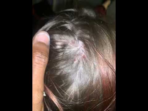 TRESemme - Horrible reaction to shampooo loss of hair dry hair and blister bumps on my...