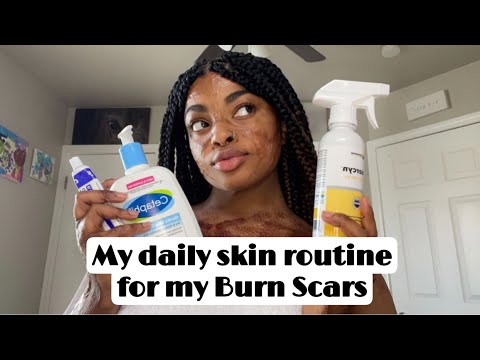 My Daily Skin-Care Routine for my Burn Scar + Update