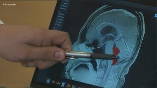 Texas doctors treat man with tapeworm in brain | KVUE